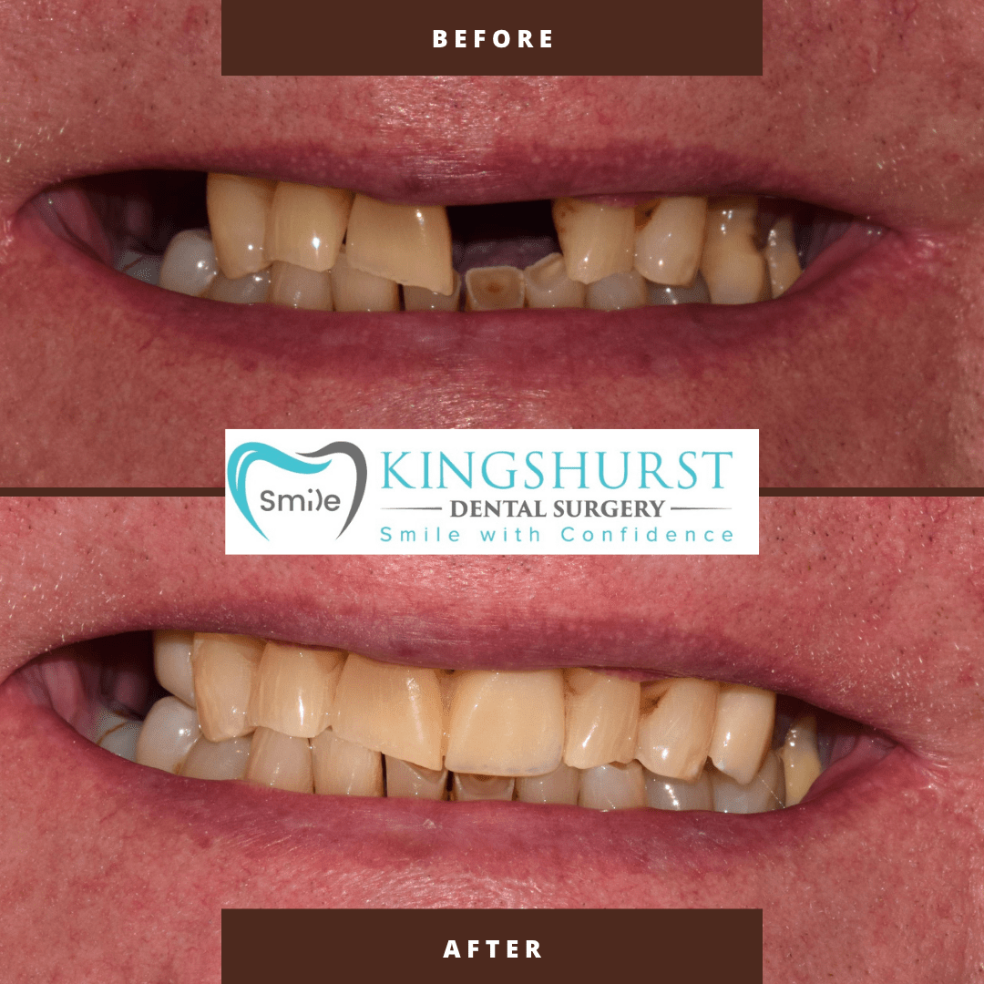 Zirconia Wing Bridge before and after