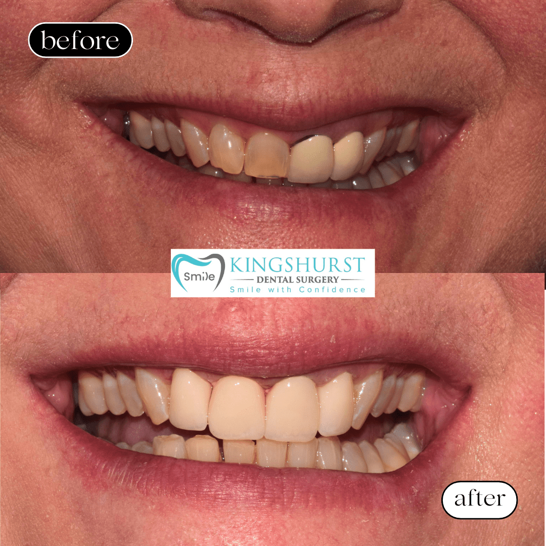 4 Crowns Upper before and after