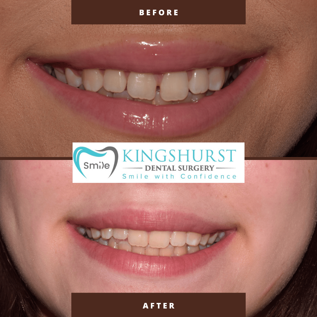Clear Aligner treatment before and after