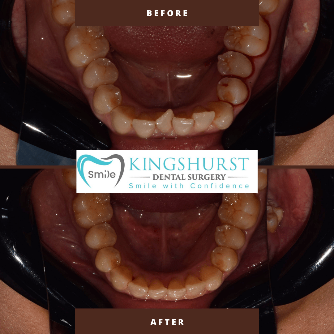 Smile makeover before and after