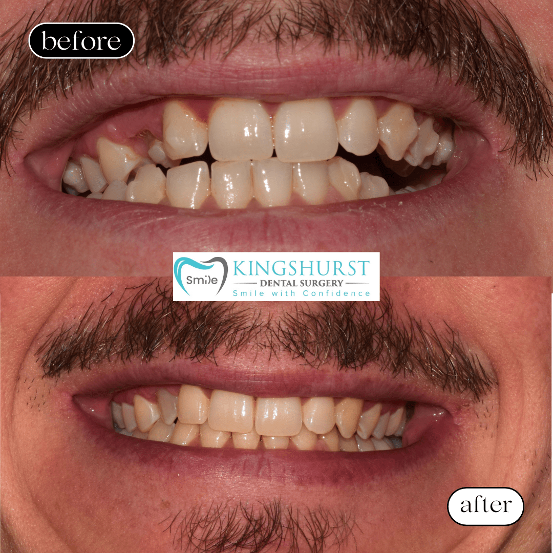 Clear Aligner treatment before and after