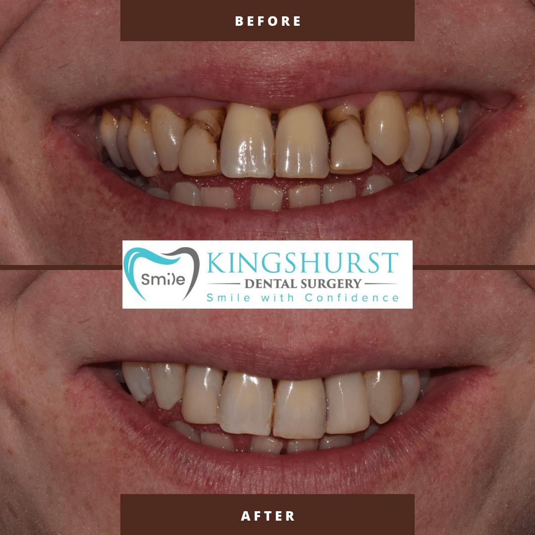 Composite Bonding before and after